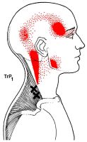 Trapezius Muscle Trigger Points and Referrals Causing Headaches