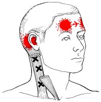 Additional Headache Producing Trigger Points and Referrals